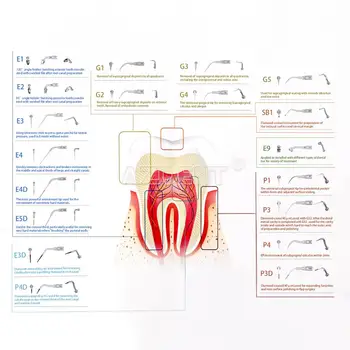 Dantų Ultragarso Scaler Patarimas Mastelio Periodontics Endodontics Tinka EMS Genys G1 G2 G3